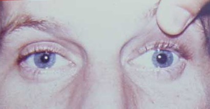 Anisocoria - Paralisia Oculomotora