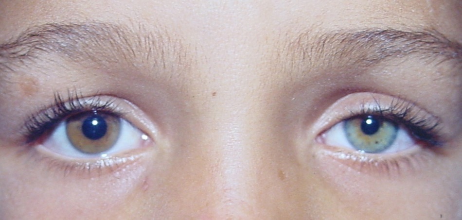 Anisocoria - Sindrome de Horner