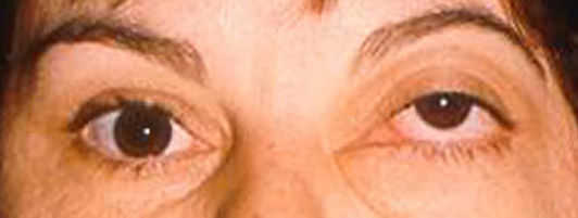 Tumor orbitário (hemangioma)